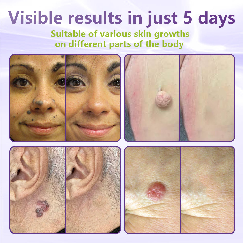 Miretha™ Soluble Microneedle Botanical Skin Tag Removal Patch
