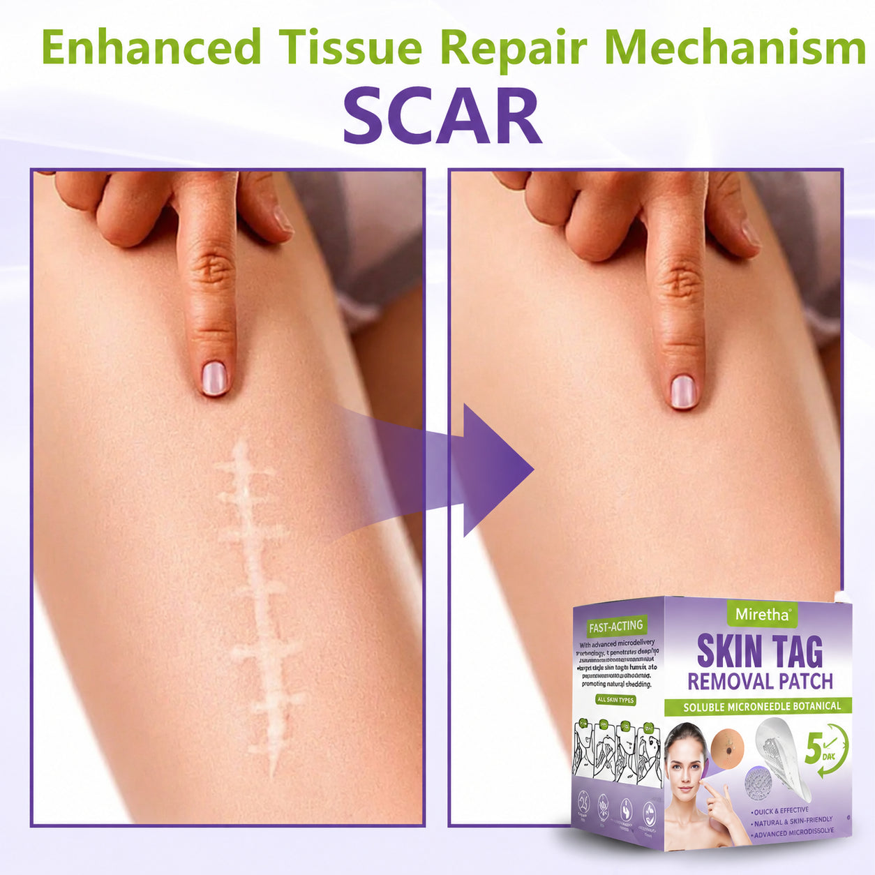 Miretha™ Soluble Microneedle Botanical Skin Tag Removal Patch