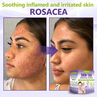 Miretha™ Soluble Microneedle Botanical Skin Tag Removal Patch