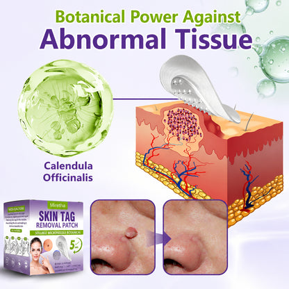 Miretha™ Soluble Microneedle Botanical Skin Tag Removal Patch