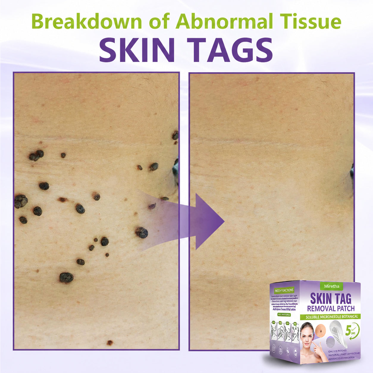 Miretha™ Soluble Microneedle Botanical Skin Tag Removal Patch